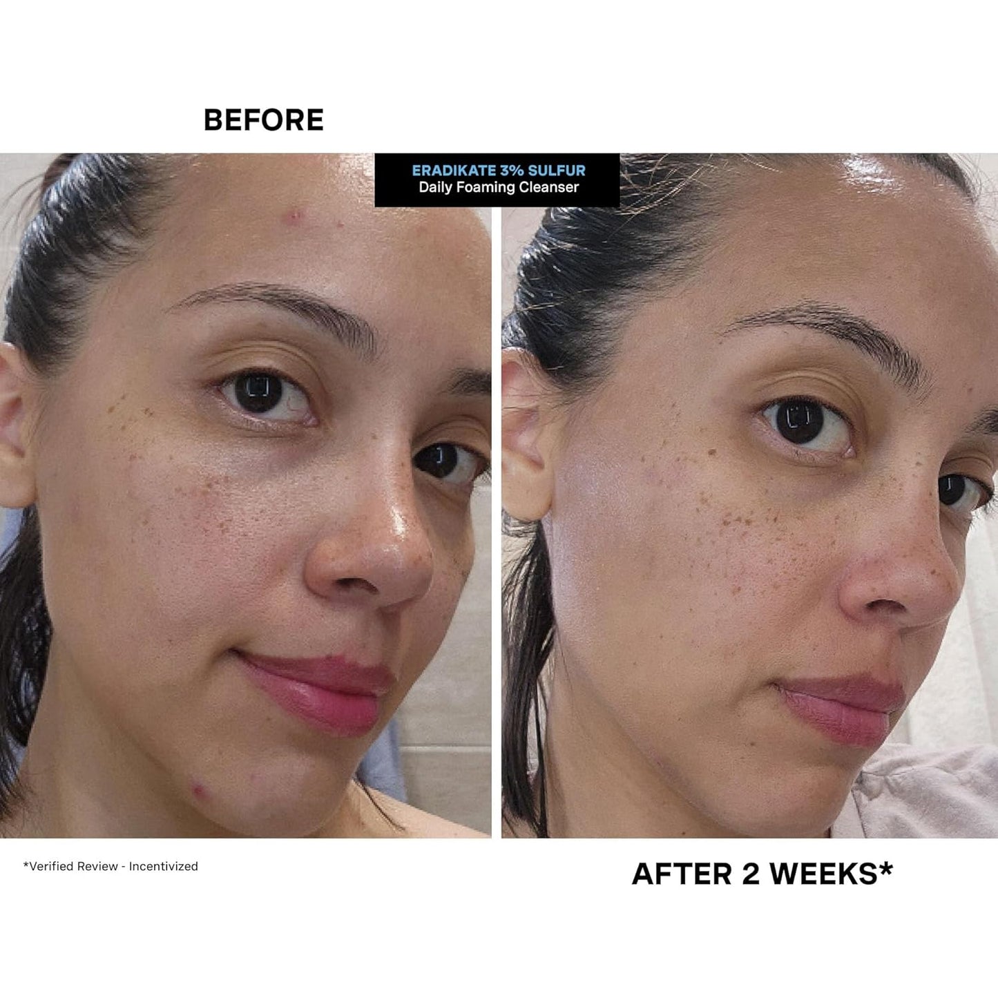 Kate Somerville EradiKate 3% Sulfur Daily Foaming Cleanser Acne Treatment – Clinically Formulated Medicated Face Wash Balances Skin and Cleans Pores, 4 Fl Oz